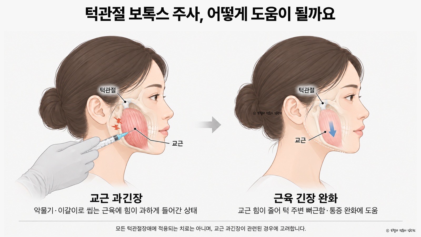 교근이 과하게 긴장한 상태에서 주사 뒤 근육 긴장이 완화되는 모습을 나란히 비교한 그림 — 교근과 턱관절 위치 표시