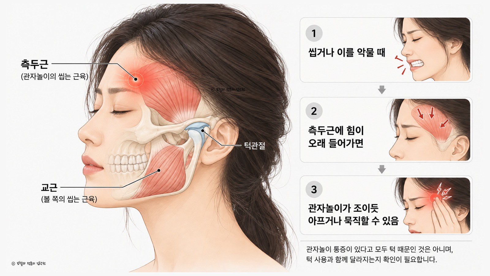 관자놀이의 측두근과 볼 쪽 교근, 턱관절 위치를 표시한 그림과 이를 악물 때 측두근에 힘이 들어가 관자놀이 통증으로 이어지는 3단계 설명